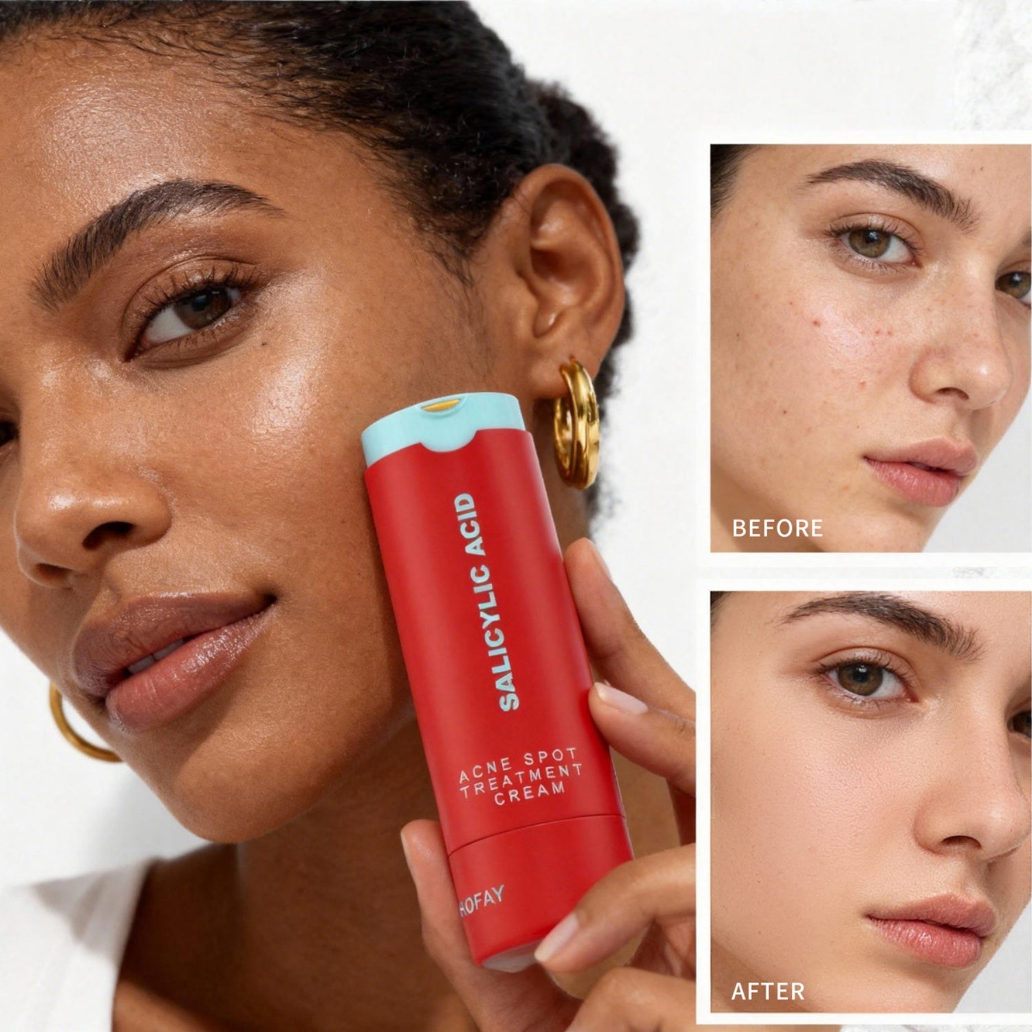 PHOFAY C-S003 Crema Trattamento Acne all'Acido Salicilico – Riduce il Rossore in 4 Ore (30g)
